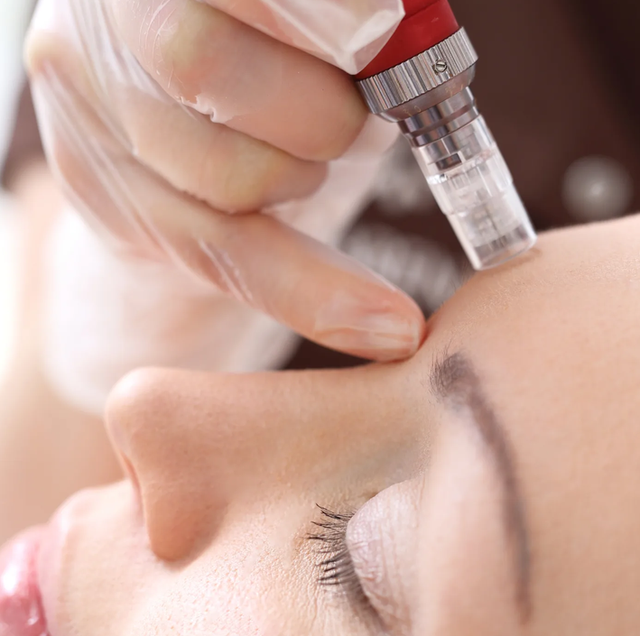 Microneedling Facial Rejuvenation